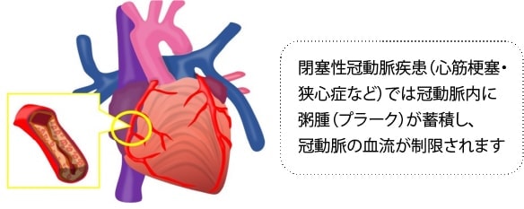 閉塞性冠動脈疾患（心筋梗塞・狭心症など）では冠動脈内に粥腫（プラーク）が蓄積し、冠動脈の血流が制限されます