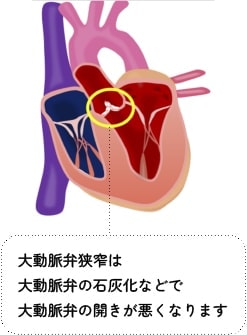 大動脈弁狭窄は大動脈弁の石灰化などで大動脈弁の開きが悪くなります